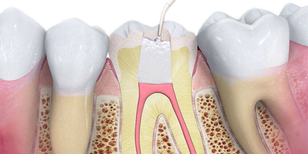 Root Canal Treatment Fort McMurray